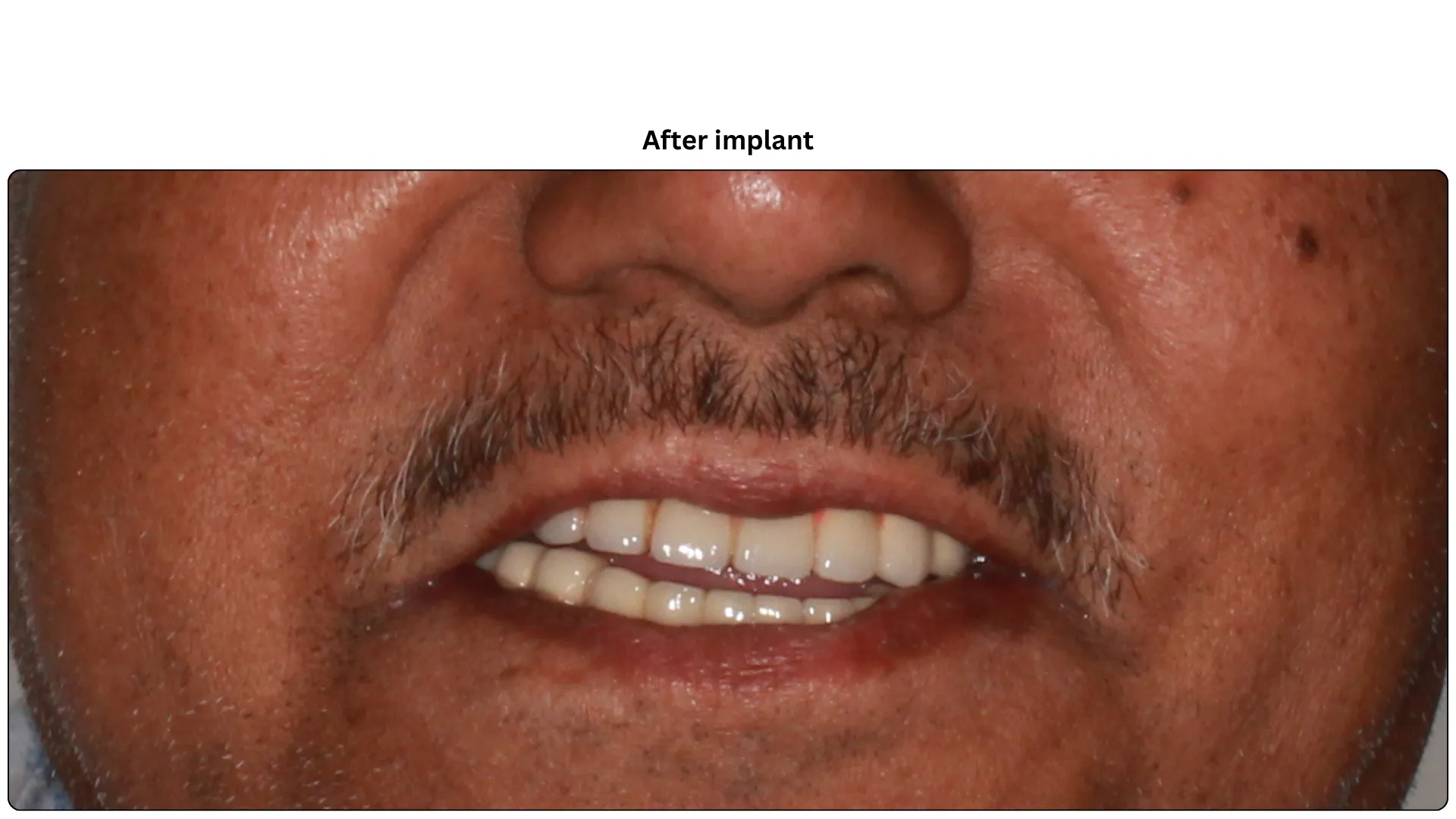 Daxayani after treatment