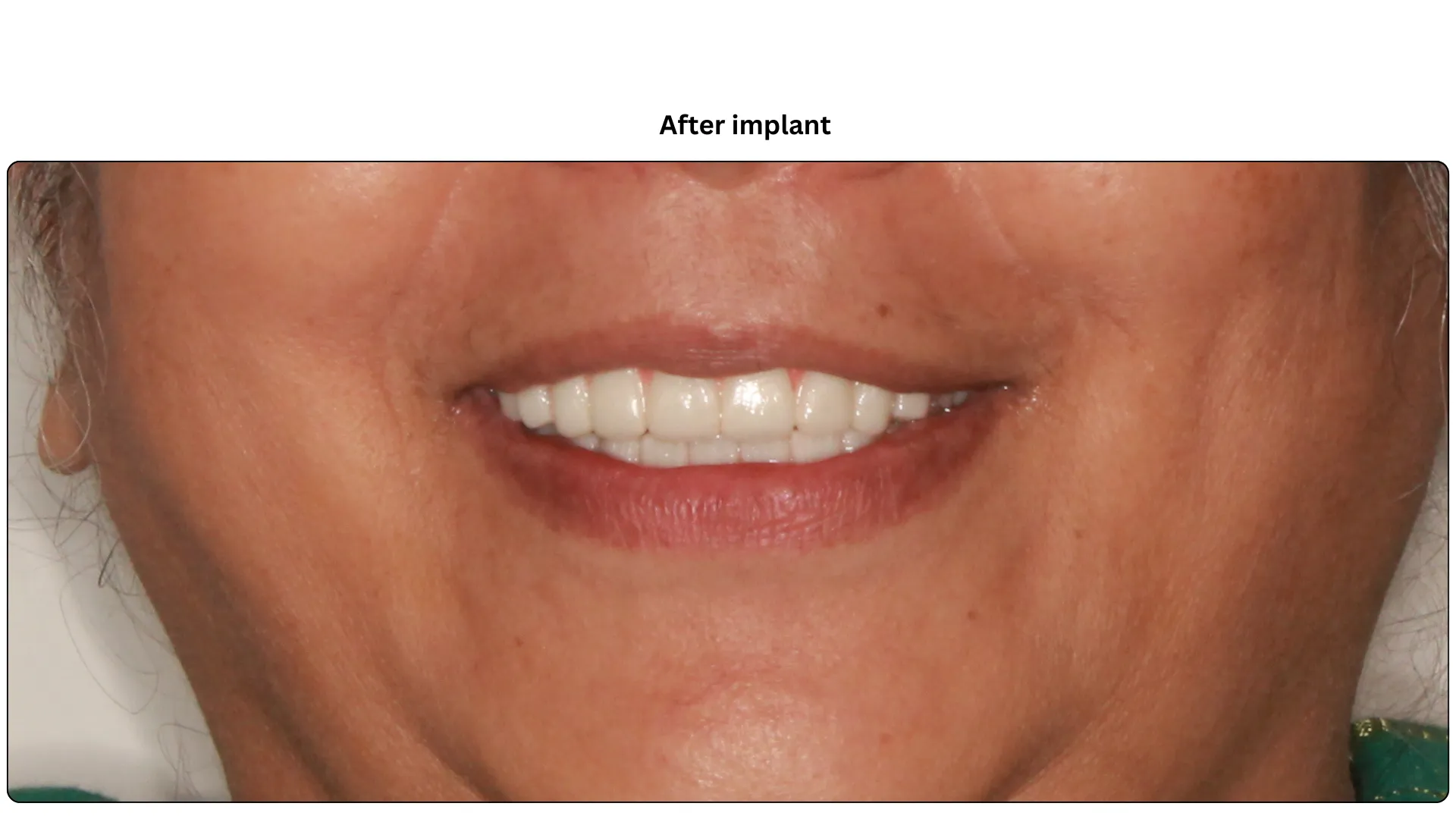 Daxayani after treatment