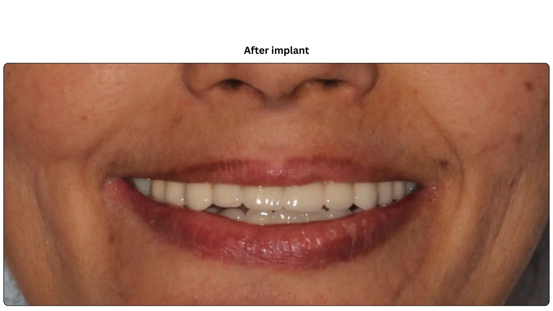 Daxayani after treatment