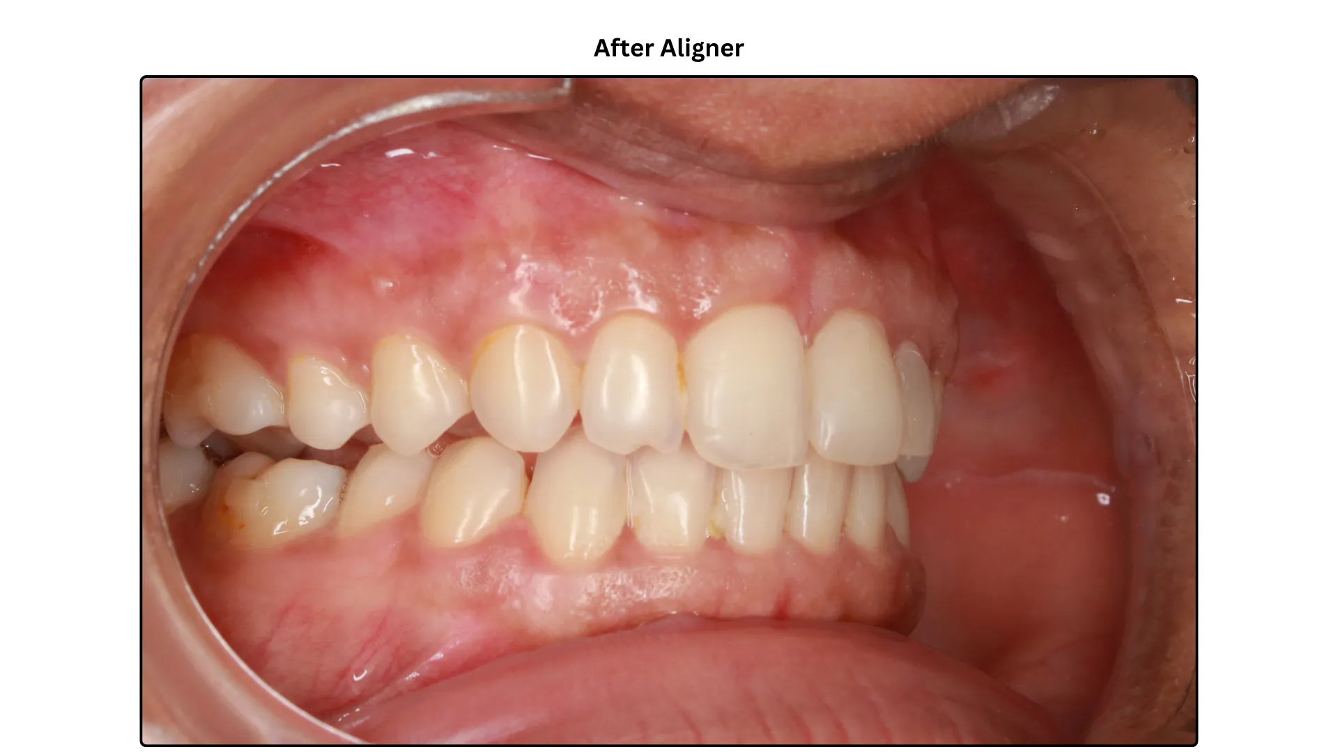 Daxayani after treatment
