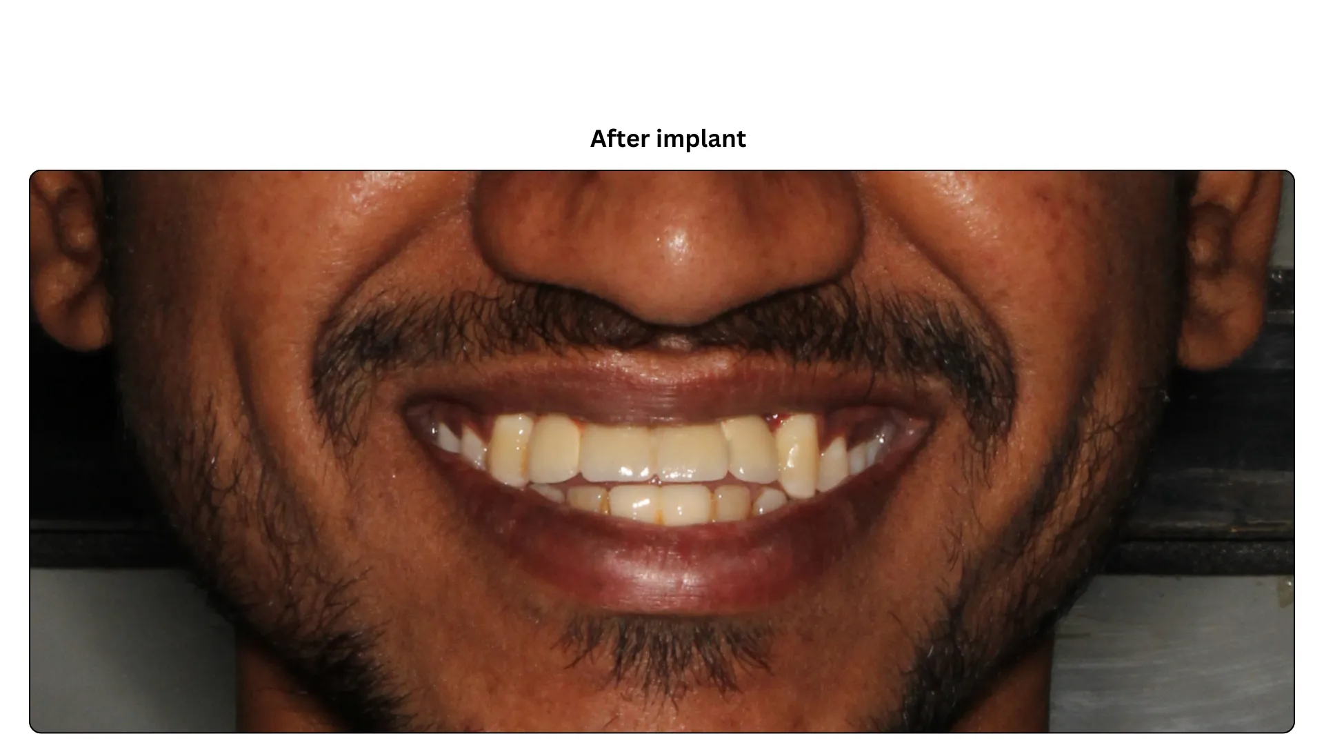 Daxayani after treatment