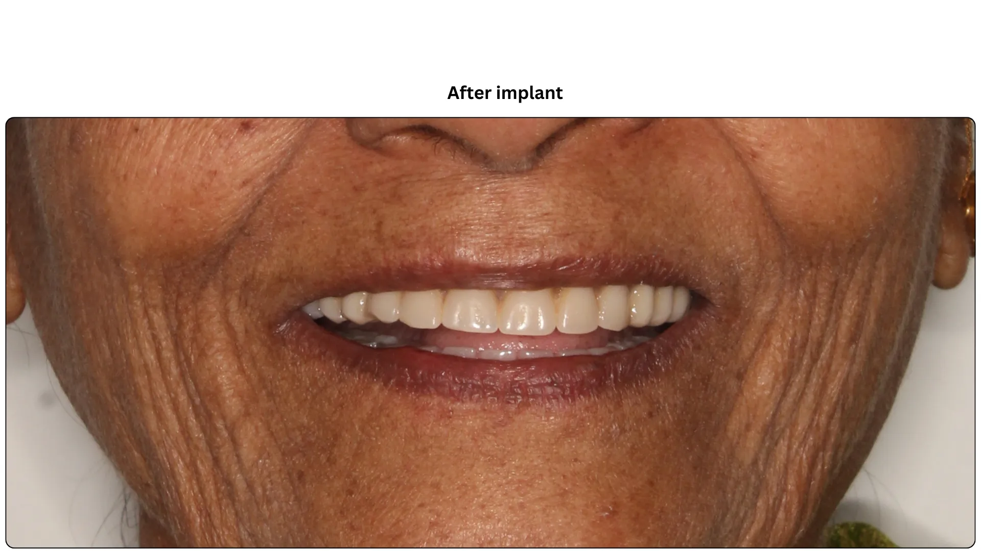 Daxayani after treatment